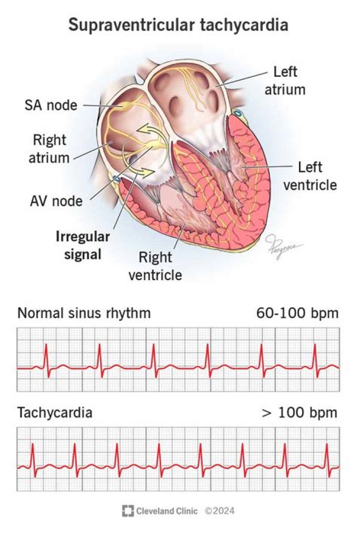 About Ventricular Tachycardia – Hollywood Life