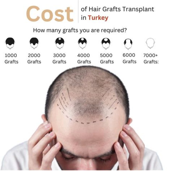 All Factors to Consider for Hair Transplant Turkey Cost in 2024