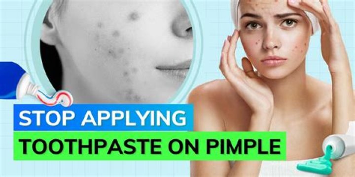 Amanda Seyfried Uses Toothpaste To Get Rid Of Pimples! Does It Work?
