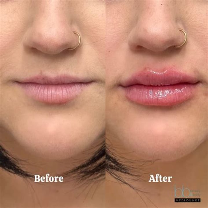 Brielle Biermann Admits Her Giant Lip Fillers ‘Looked Crazy’ Last Year: ‘I’m Over’ Ones That ‘Big’