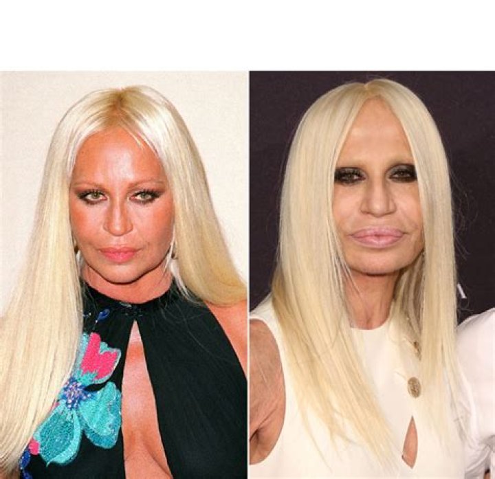 Donatella Versace’s Plastic Surgery — Experts Weight In – Hollywood Life