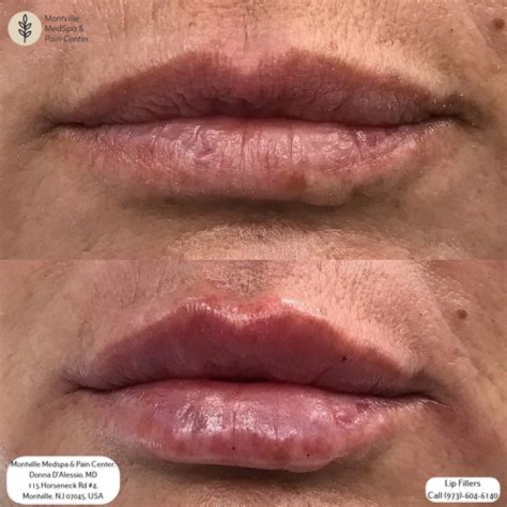 Farrah Abraham Banned From Lip Implants On ‘Botched’: Is She Destroying Her Face?