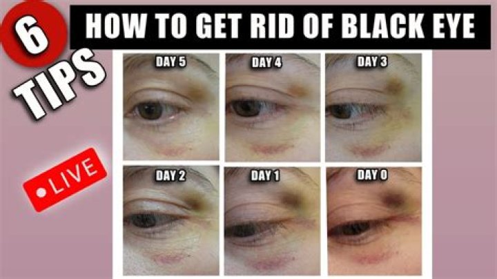 Heather Morris' Black Eye Pics!