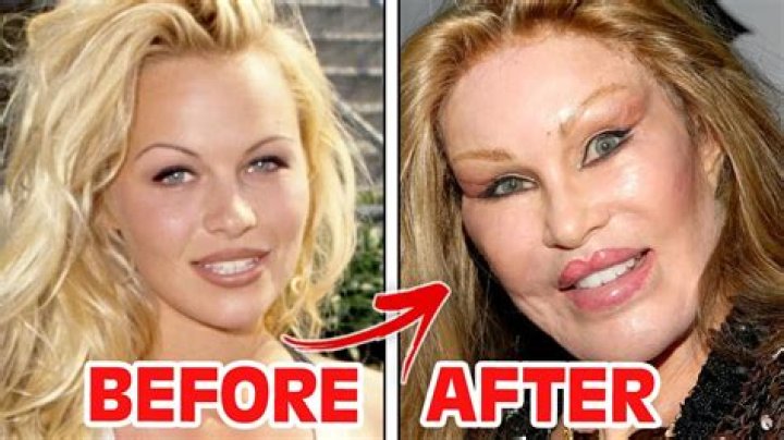 How They Changed After Plastic Surgery – Hollywood Life