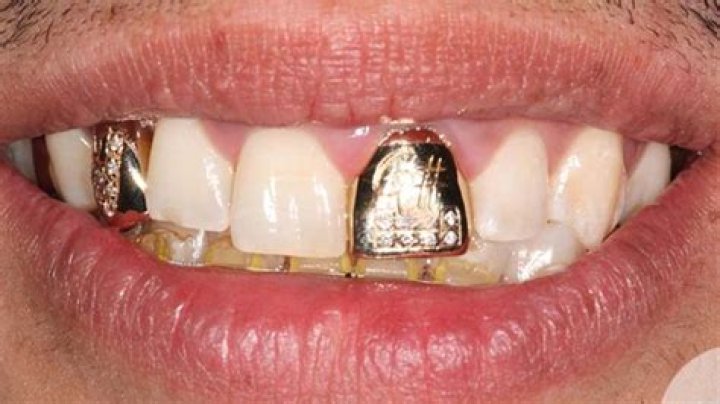 Justin Bieber Flaunts Crazy Shiny New Gold Tooth — Pic