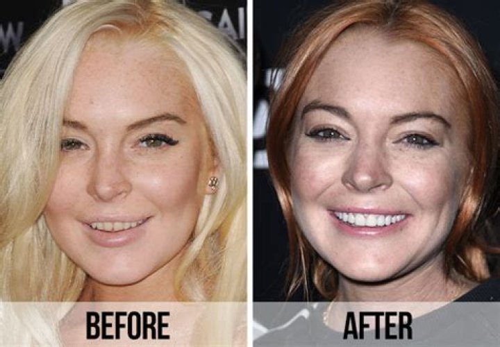Lindsay Lohan's Tooth Decay Caused By Cigarettes, Poor Hygiene & Possible Drug Use! – Hollywood Life