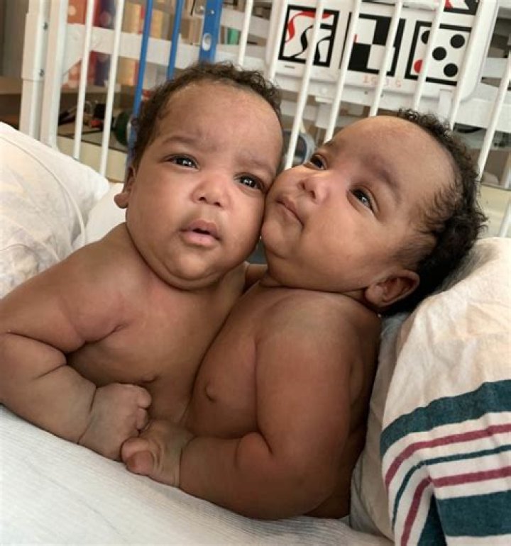 [PHOTOS] Australian Baby Two Faces, Conjoined Twins Faith & Hope Born In Sydney – Hollywood Life