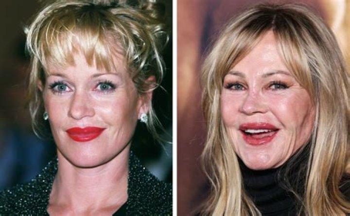 Photos Stars Who’ve Admitted To Plastic Surgery – Hollywood Life