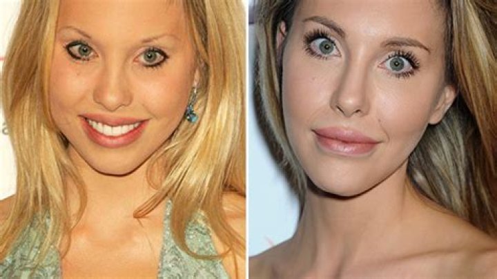 [PICS] Chloe Lattanzi’s Plastic Surgery Before & After Pics: – Hollywood Life