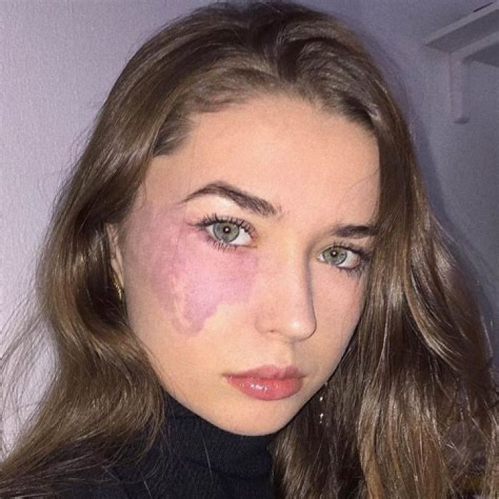 [PICS] Dancer With Birthmark On Face — Cassandra Naud Refuses To Remove It – Hollywood Life