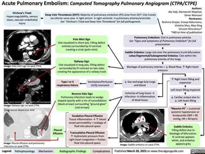 Pulmonary Embolism: What Duane Chapman’s Dangerous Condition Is & How It’s Treated: Docs Explain