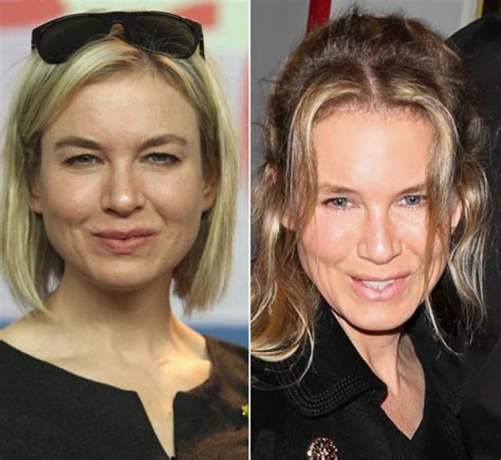 Renee Zellweger’s Face — She Got Plastic Surgery, Docs Say – Hollywood Life