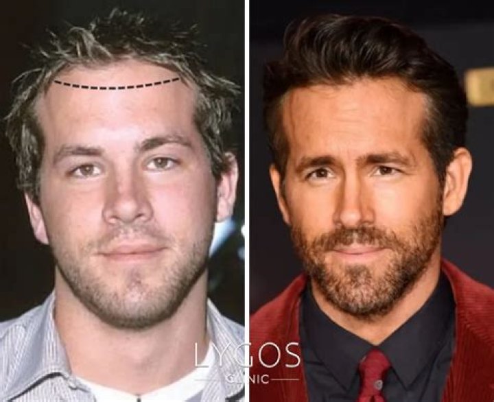 See Hair Transplant Makeover – Hollywood Life