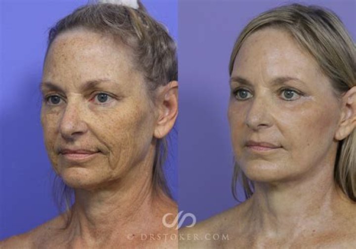 Sonja Morgan Reveals She Got A Neck & Face Lift — Before & After – Hollywood Life