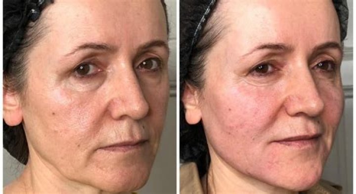 This Cult-Favorite Body Treatment System Helps Get Rid Of Saggy Dry Skin & It’s Currently 50% Off