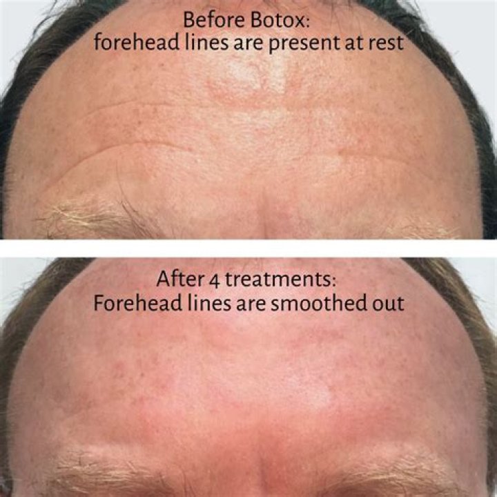 TikTok Is Raving About This Botox Alternative That Can Smooth Forehead Lines In One Night