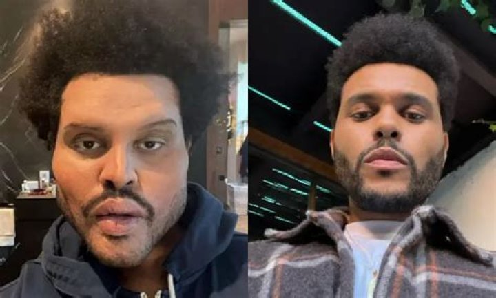What Happened To The Weeknd’s Face? Shocking News – Hollywood Life