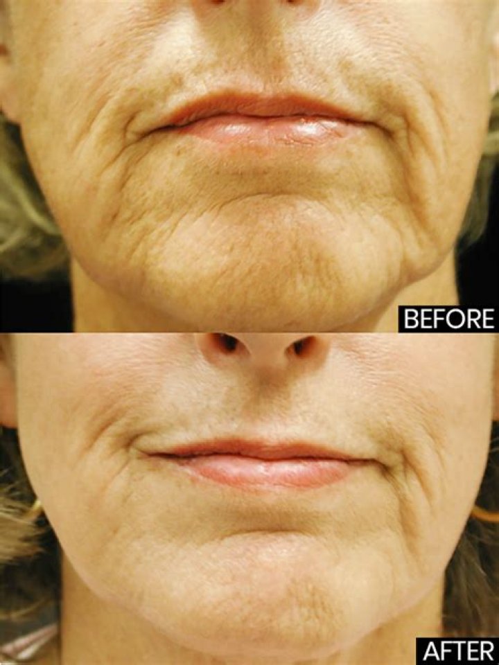 What Is Microneedling Celebrity Ageless Skin Treatment? – Hollywood Life