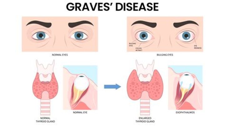 Why Graves Disease Can Make Her Eyes Seem To Bulge – Hollywood Life